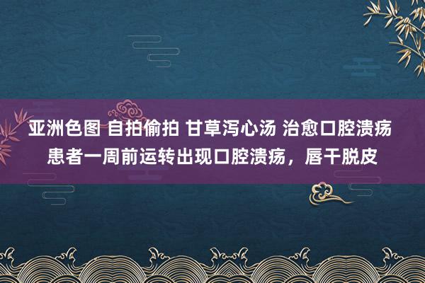 亚洲色图 自拍偷拍 甘草泻心汤 治愈口腔溃疡 患者一周前运转出现口腔溃疡，唇干脱皮